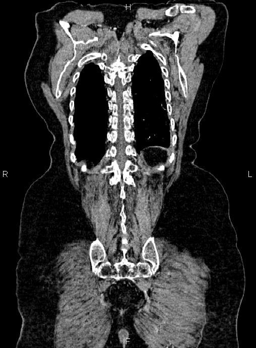 Abdominal aortic aneurysm (Radiopaedia 85063-100606 Coronal C+ arterial phase 53).jpg