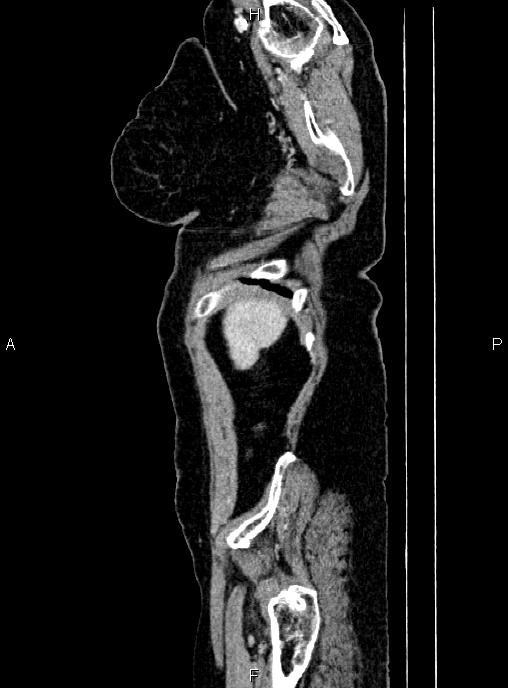 Abdominal aortic aneurysm (Radiopaedia 85063-100606 Sagittal C+ arterial phase 3).jpg