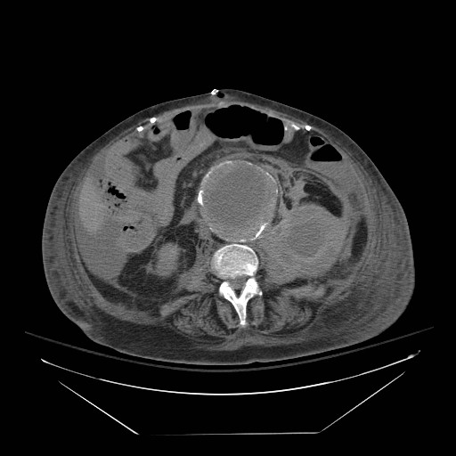 Abdominal aortic aneurysm - impending rupture (Radiopaedia 19233-19247 Axial non-contrast 93).jpg