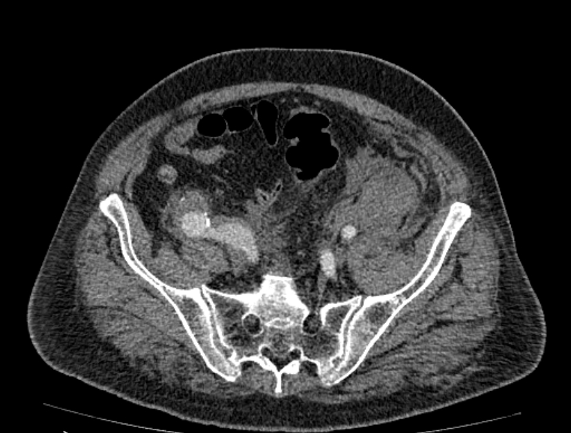 Abdominal aortic aneurysm rupture (Radiopaedia 54179-60362 Axial C+ arterial phase 46).jpg