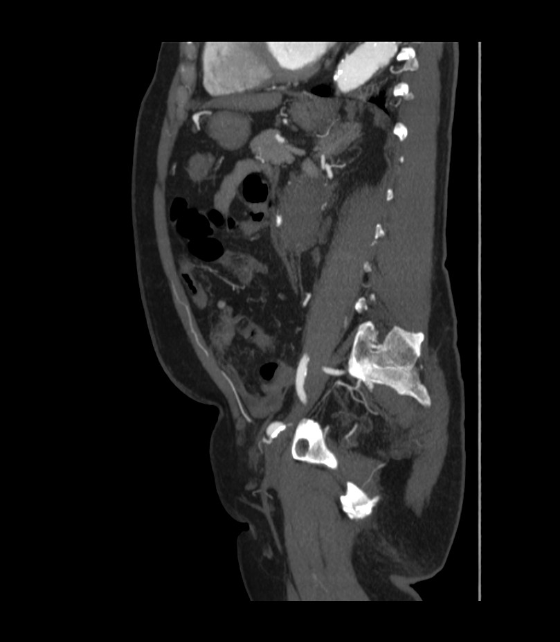 Abdominal aortic aneurysm with thrombus fissuration (Radiopaedia 46218-50618 Sagittal C+ arterial phase 38).jpg