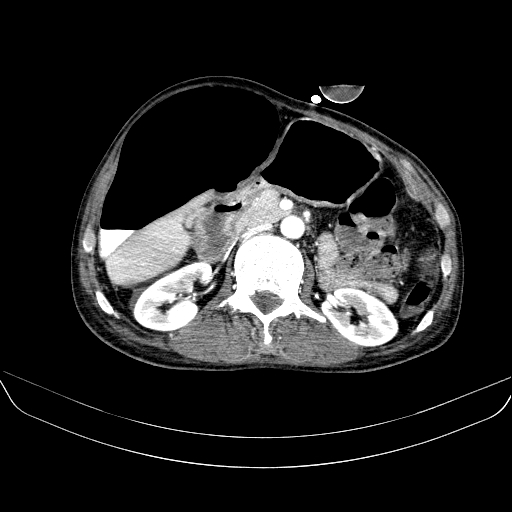 File:Abdominal collection due to previous cecal perforation (Radiopaedia 80831-94320 Axial C+ portal venous phase 81).jpg