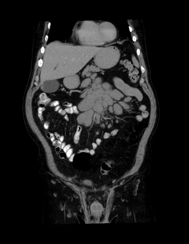 Abdominal lymphoma - with sandwich sign (Radiopaedia 53486-59492 C+ portal venous phase 42).jpg