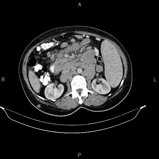 File:Abdominal lymphoma with sandwich sign (Radiopaedia 84378-99704 Axial C+ portal venous phase 25).jpg