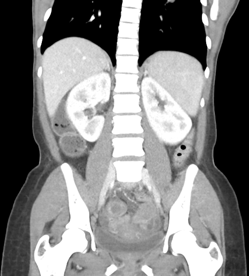 File:Abdominal tuberculosis and appendicitis (Radiopaedia 65631-74735 Coronal C+ portal venous phase 31).png