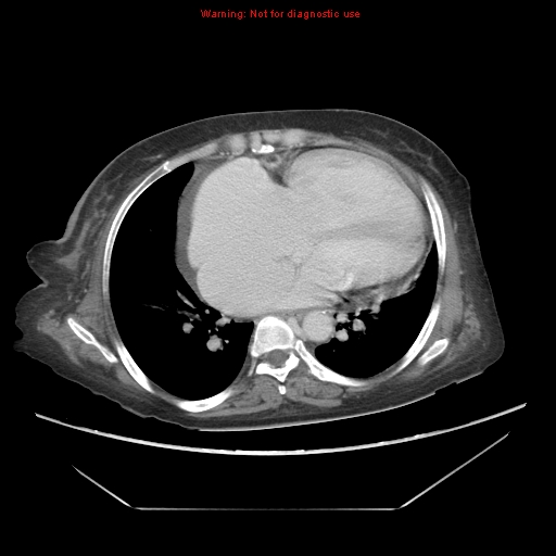 File:Abdominal wall hematoma (Radiopaedia 9427-10112 Axial C+ portal venous phase 4).jpg