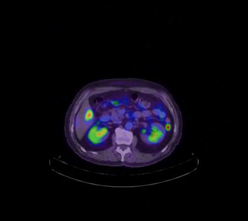 Abdominal wall metastasis from colorectal carcinoma (Radiopaedia 31016-31719 Axial 72).jpg