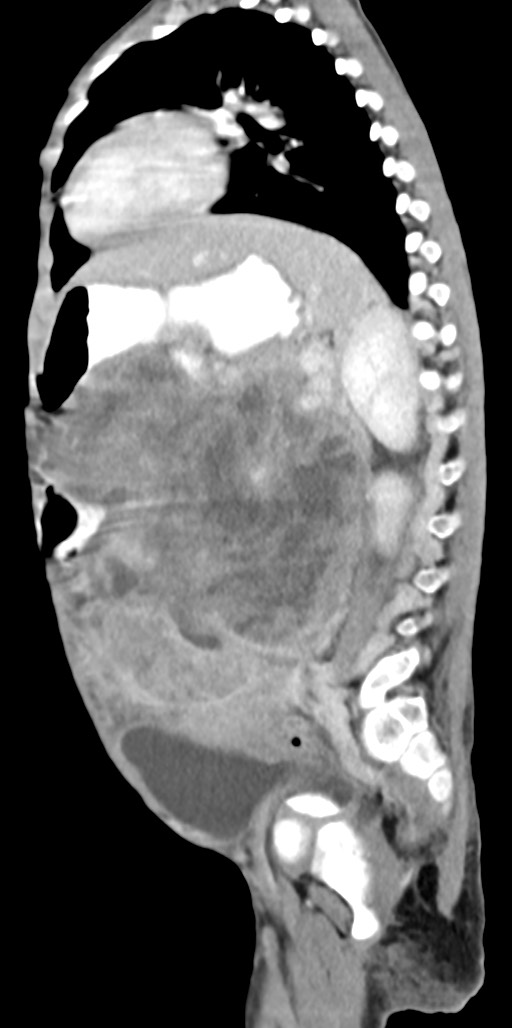 Abdominopelvic rhabdomyosarcoma (Radiopaedia 78356-90984 Sagittal C+ portal venous phase 35).jpg