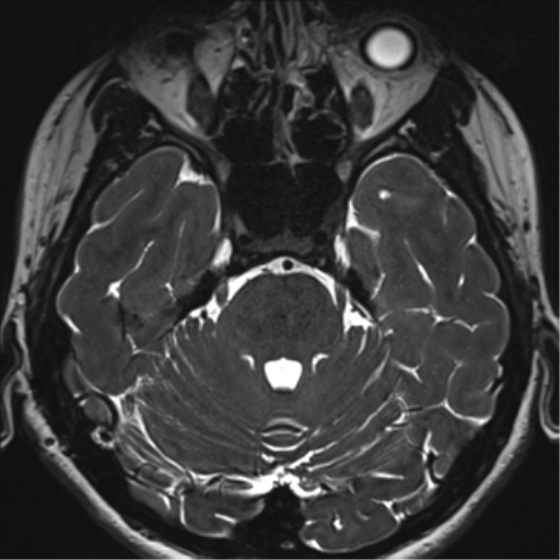 Abducens nerve palsy (Radiopaedia 51069-56648 Axial T2 fat sat 37).png