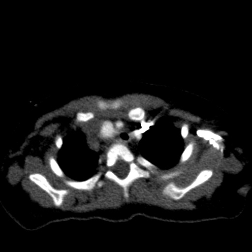 File:Aberrant left pulmonary artery (pulmonary sling) (Radiopaedia 42323-45435 Axial C+ CTPA 11).jpg