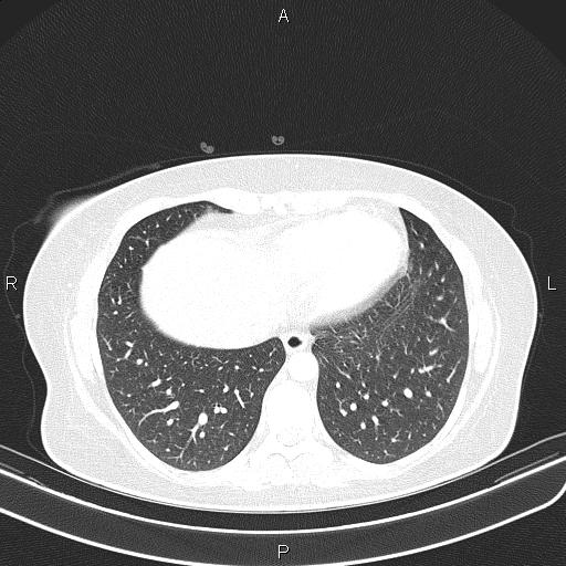 File:Aberrant right subclavian artery (Radiopaedia 87334-103629 Axial lung window 50).jpg