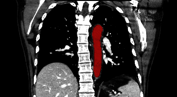 File:Aberrant right subclavian artery (Radiopaedia 9379-38993 Coronal 4).jpg