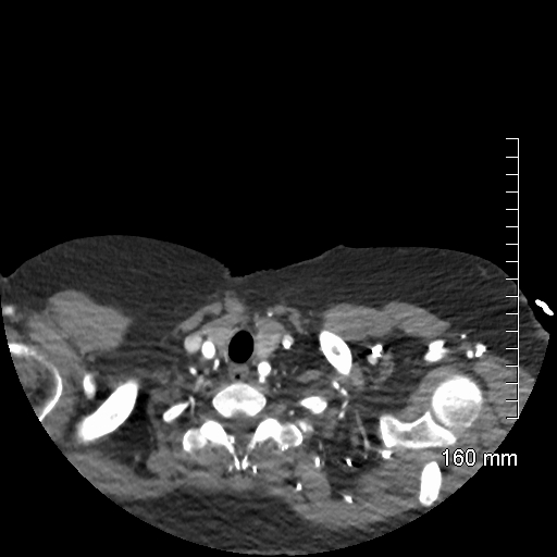 Aberrant right subclavian artery stenosis (Radiopaedia 52656-58670 Axial C+ arterial phase 3).jpg