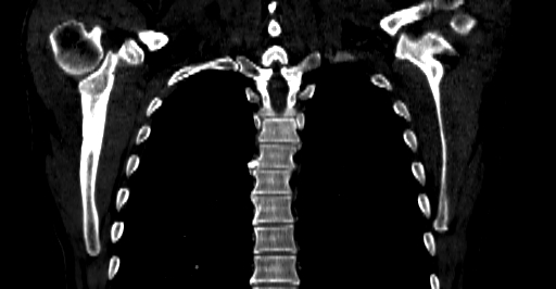 Accesory rib joint (Radiopaedia 71987-82452 Coronal bone window 39).jpg