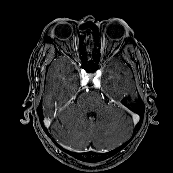 Accessory middle cerebral artery (Radiopaedia 73114-83828 Axial MRA 51).jpg