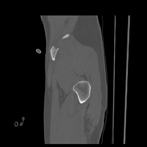 Acetabular and ilial fractures (Radiopaedia 59084-66378 Sagittal bone window 8).jpg