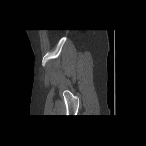 File:Acetabular fracture (Radiopaedia 13193-13212 Sagittal bone window 11).jpg