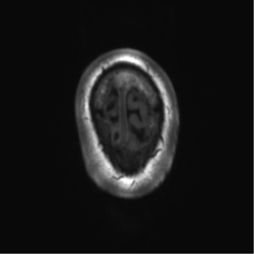 File:Achondroplasia (Radiopaedia 65109-74105 Axial T1 3).png
