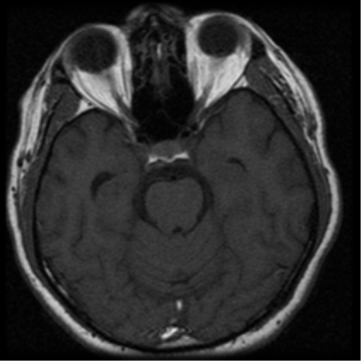 File:Acoustic schwannoma (Radiopaedia 33045-34060 Axial T1 12).png