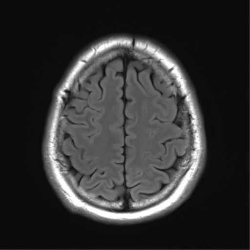 File:Acoustic schwannoma (Radiopaedia 50846-56358 Axial FLAIR 26).png