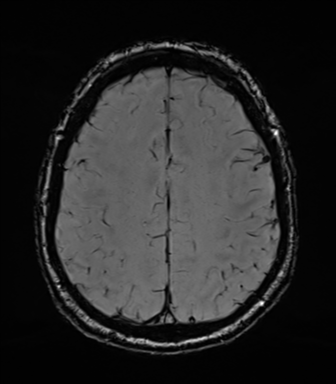 File:Acoustic schwannoma (Radiopaedia 50846-56358 Axial SWI 70).png