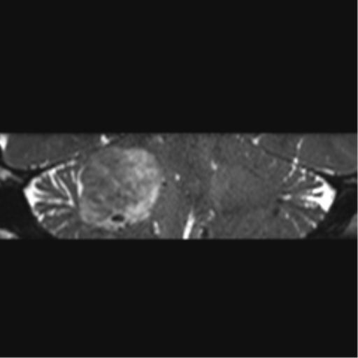 File:Acoustic schwannoma (Radiopaedia 50846-56358 Coronal T2 15).png