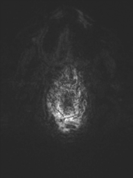 File:Acoustic schwannoma (Radiopaedia 55729-62281 Axial SWI 54).png