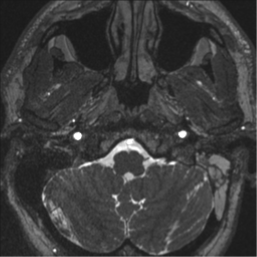 Acoustic schwannoma (translabyrinthine resection) (Radiopaedia 43570-46972 Axial CISS 8).png