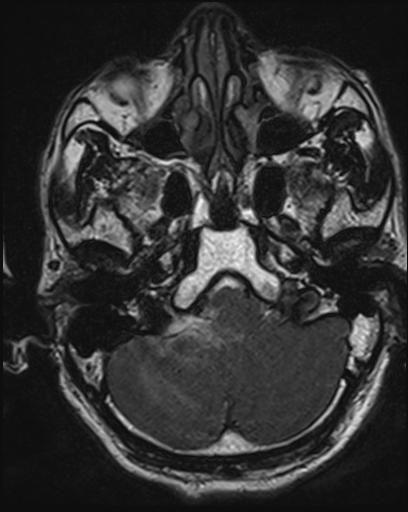 Acoustic schwannoma - probable (Radiopaedia 20386-20292 Axial T1 28).jpg