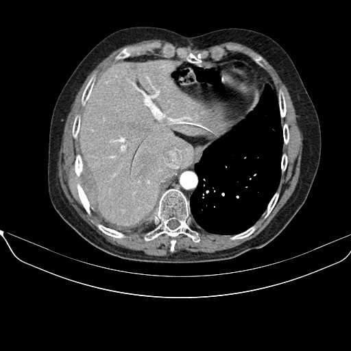 File:Acquired adrenal hyperplasia - due to thymic carcinoid tumor (Radiopaedia 21269-21184 C+ arterial phase 2).jpg