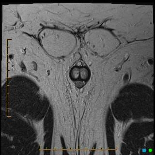 File:Acquired buried penis (Radiopaedia 39478-41797 Axial T2 15).jpg