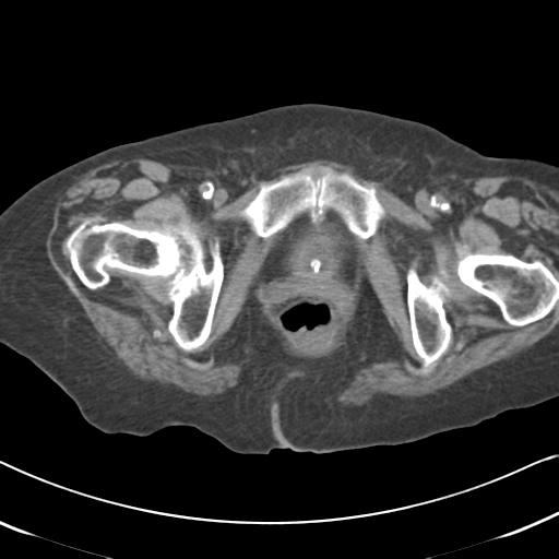 Active bleeding from duodenal ulcer with embolization (Radiopaedia 34216-35481 Axial non-contrast 69).png