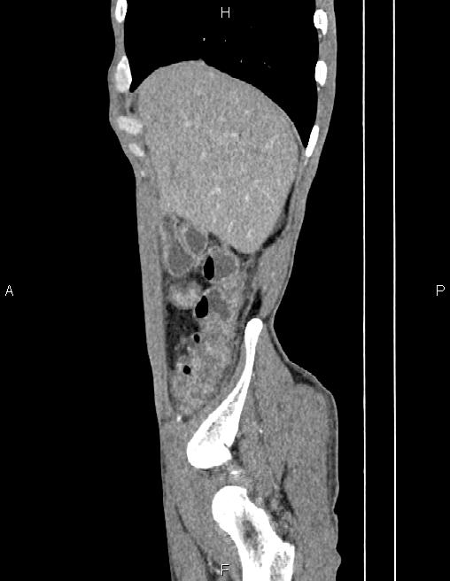 Active crohn disease (Radiopaedia 87133-103397 Sagittal C+ arterial phase 10).jpg
