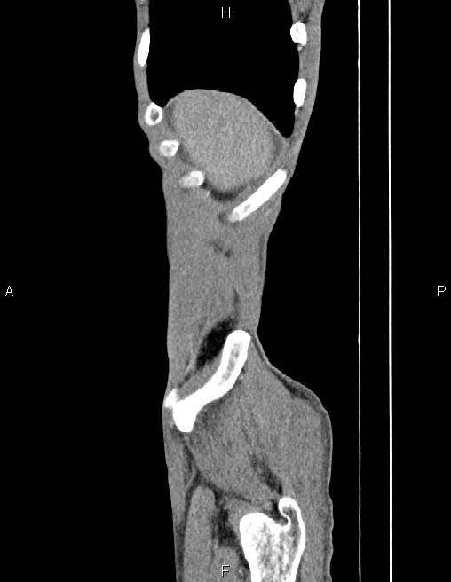 Active crohn disease (Radiopaedia 87133-103397 Sagittal C+ arterial phase 5).jpg