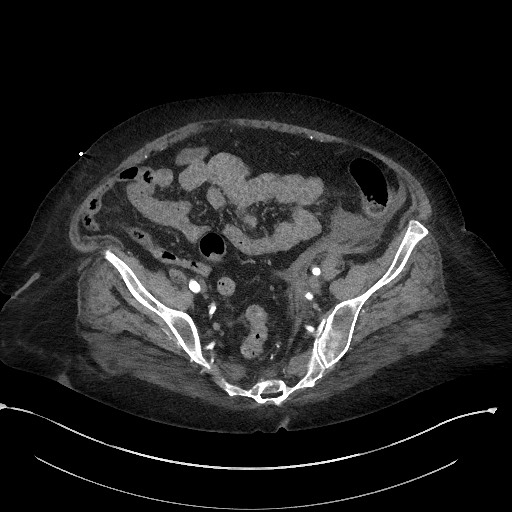 Active renal extravasation with large subcapsular and retroperitoneal hemorrhage (Radiopaedia 60975-68796 Axial C+ arterial phase 152).jpg