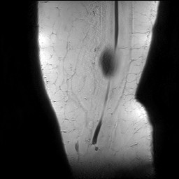 Acute-on-chronic transient lateral patellar dislocation with trochlear dysplasia (Radiopaedia 84099-99349 Sagittal PD 5).jpg