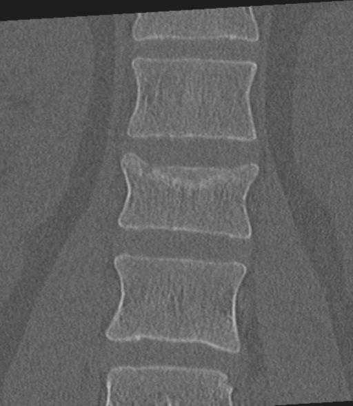 Acute L1 burst compression fracture (Radiopaedia 34430-35755 Coronal bone window 27).png