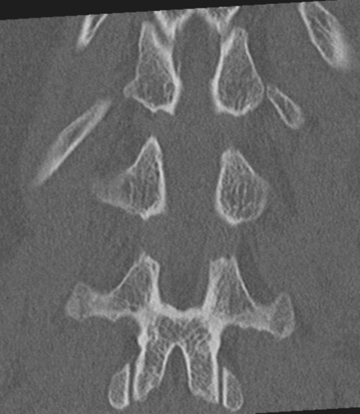 Acute L1 burst compression fracture (Radiopaedia 34430-35755 Coronal bone window 43).png