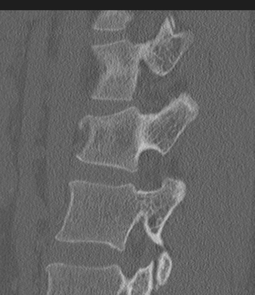 Acute L1 burst compression fracture (Radiopaedia 34430-35755 Sagittal bone window 44).png