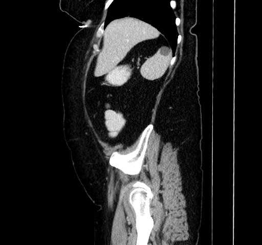 Acute appendicitis, heterotaxy syndrome (Radiopaedia 66884-76202 Sagittal C+ portal venous phase 34).jpg