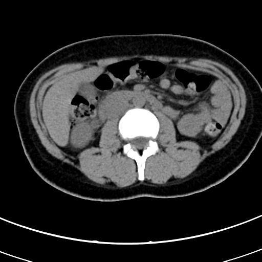 Acute appendicitis (Radiopaedia 30261-30888 Axial non-contrast 34).jpg