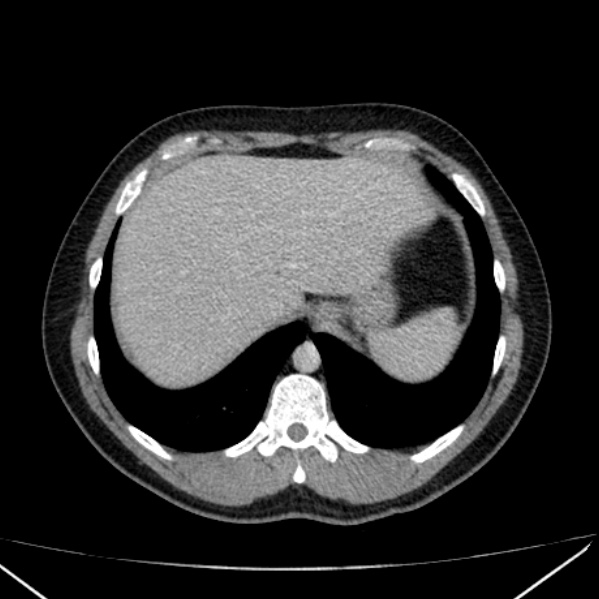 Acute appendicitis (Radiopaedia 38255-40270 Axial C+ portal venous phase 13).jpg