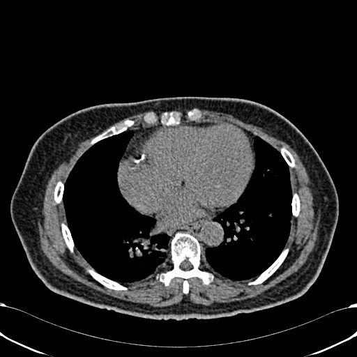 Acute appendicitis (Radiopaedia 58627-65818 Axial non-contrast 5).jpg