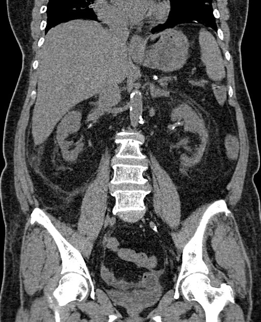 Acute appendicitis (Radiopaedia 58627-65818 Coronal non-contrast 43).jpg