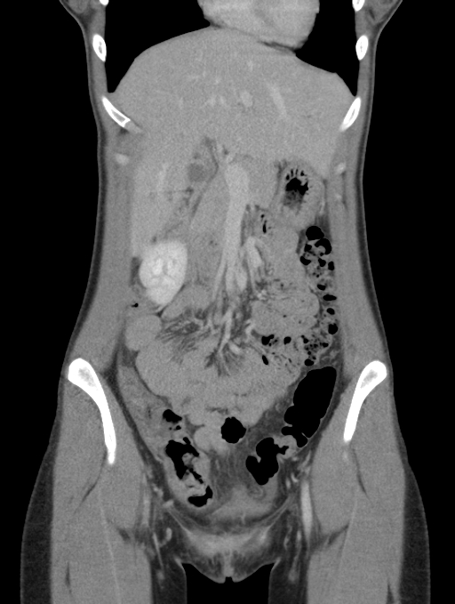 Acute appendicitis (Radiopaedia 62608-70901 Coronal C+ portal venous phase 12).jpg