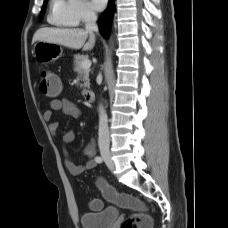 Acute appendicitis (Radiopaedia 66513-75790 Sagittal C+ portal venous phase 77).jpg