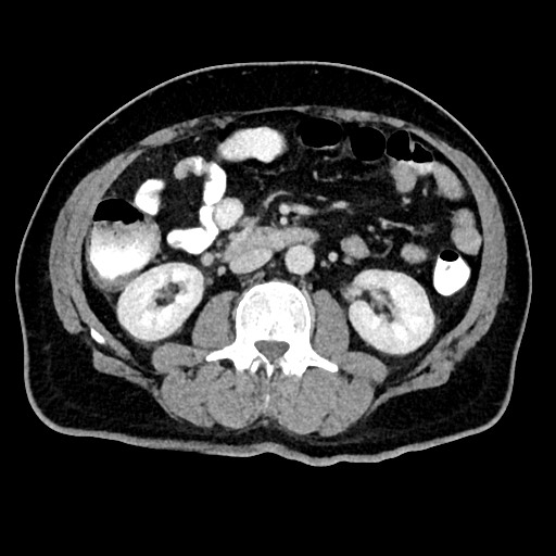 Acute appendicitis (Radiopaedia 77016-88960 Axial C+ portal venous phase 68).jpg
