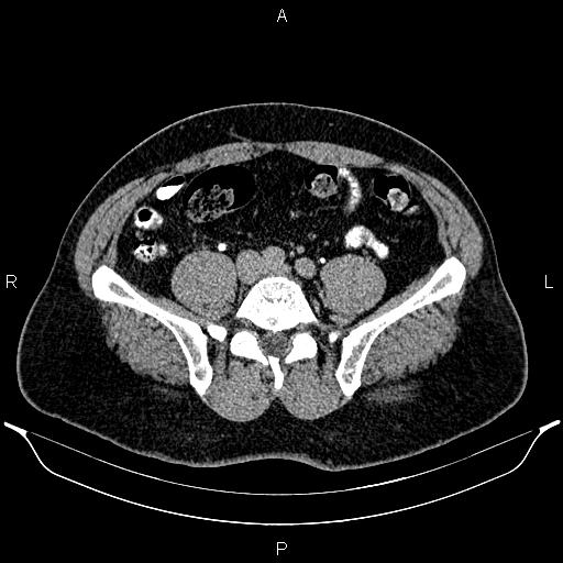 Acute appendicitis (Radiopaedia 84780-100240 Axial C+ delayed 73).jpg
