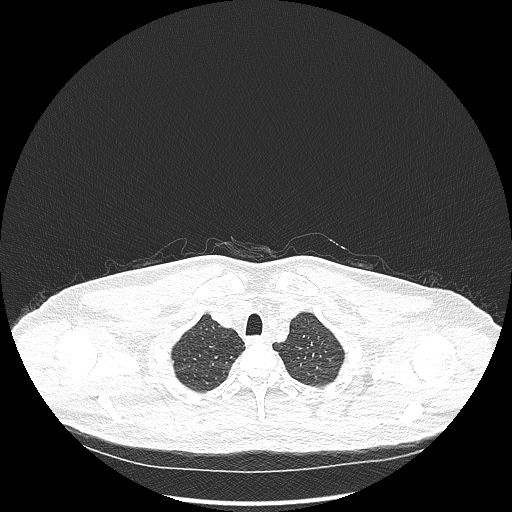 Acute appendicitis and COVID 19 pneumonia (Radiopaedia 76604-88380 Axial lung window 9).jpg