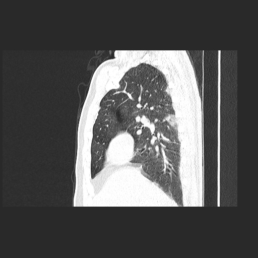 Acute appendicitis and COVID 19 pneumonia (Radiopaedia 76604-88380 Sagittal lung window 33).jpg